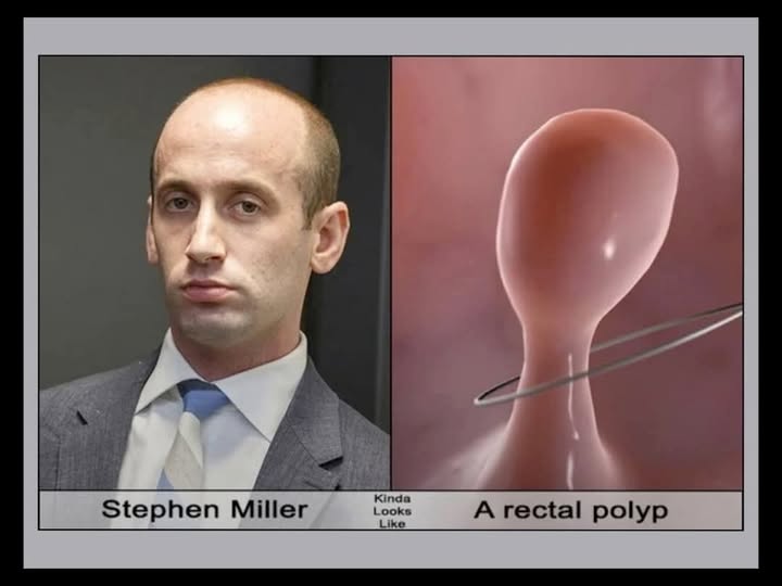 miller polyp.jpg