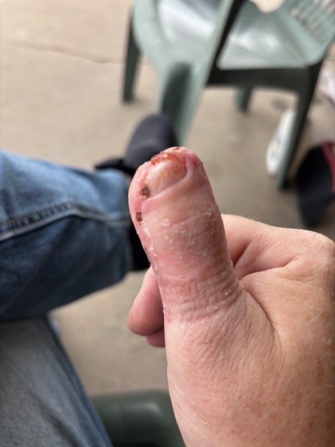 Thumb update.jpg